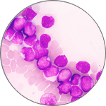 Stylized BPDCN cells colored purple